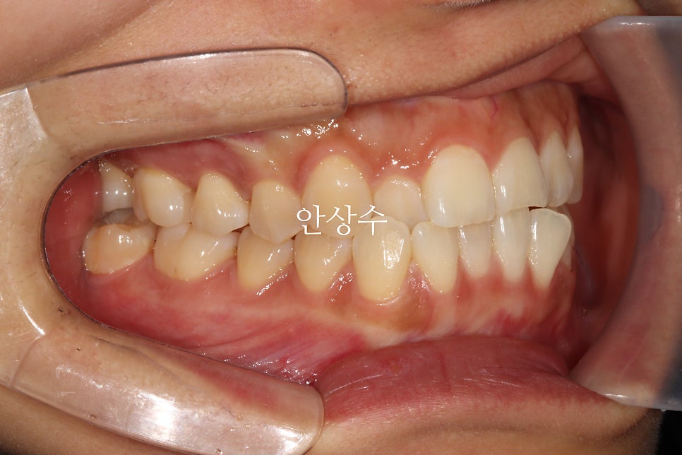 인비절라인 라이트, 철사교정과 비슷한 가격으로 인비절라인 치료하는 방법