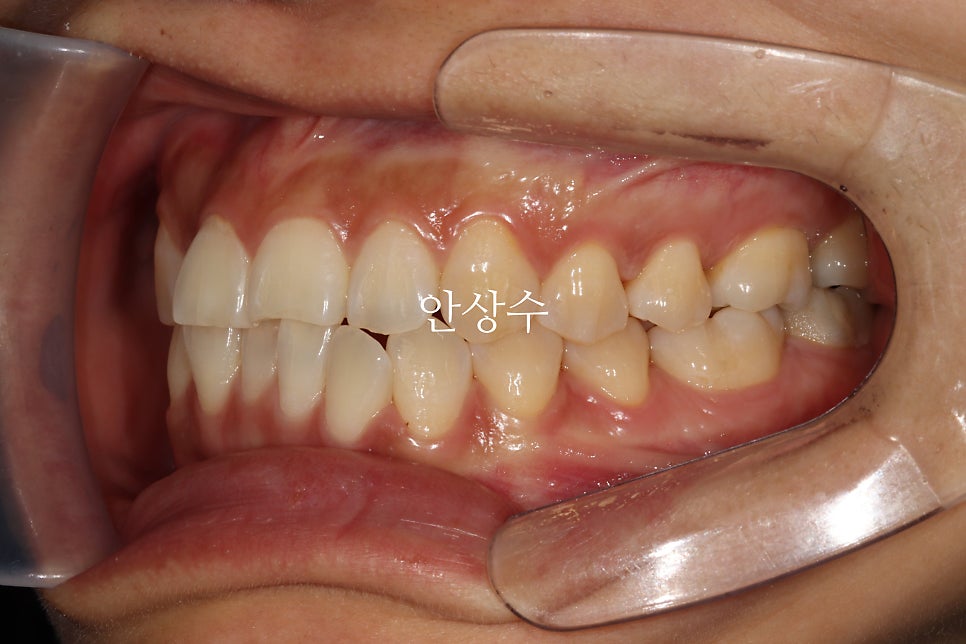 인비절라인 라이트, 철사교정과 비슷한 가격으로 인비절라인 치료하는 방법
