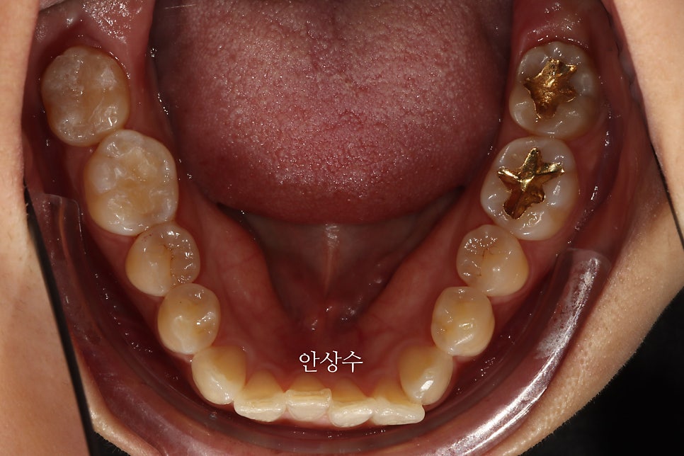 인비절라인 라이트, 철사교정과 비슷한 가격으로 인비절라인 치료하는 방법