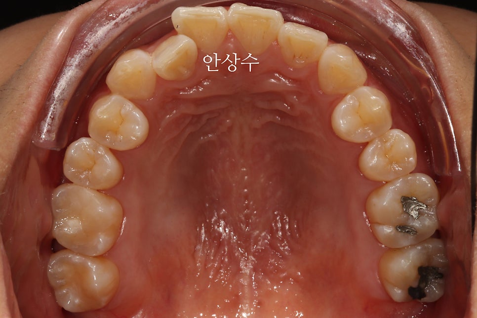 인비절라인 라이트, 철사교정과 비슷한 가격으로 인비절라인 치료하는 방법