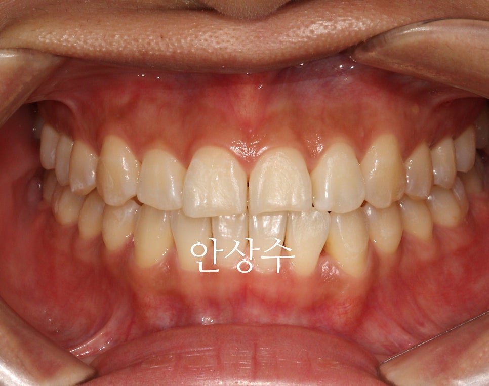 인비절라인 라이트, 철사교정과 비슷한 가격으로 인비절라인 치료하는 방법