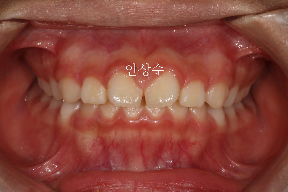 인비절라인 라이트 치료 모습 공유 돌출입? 2급 부정교합
