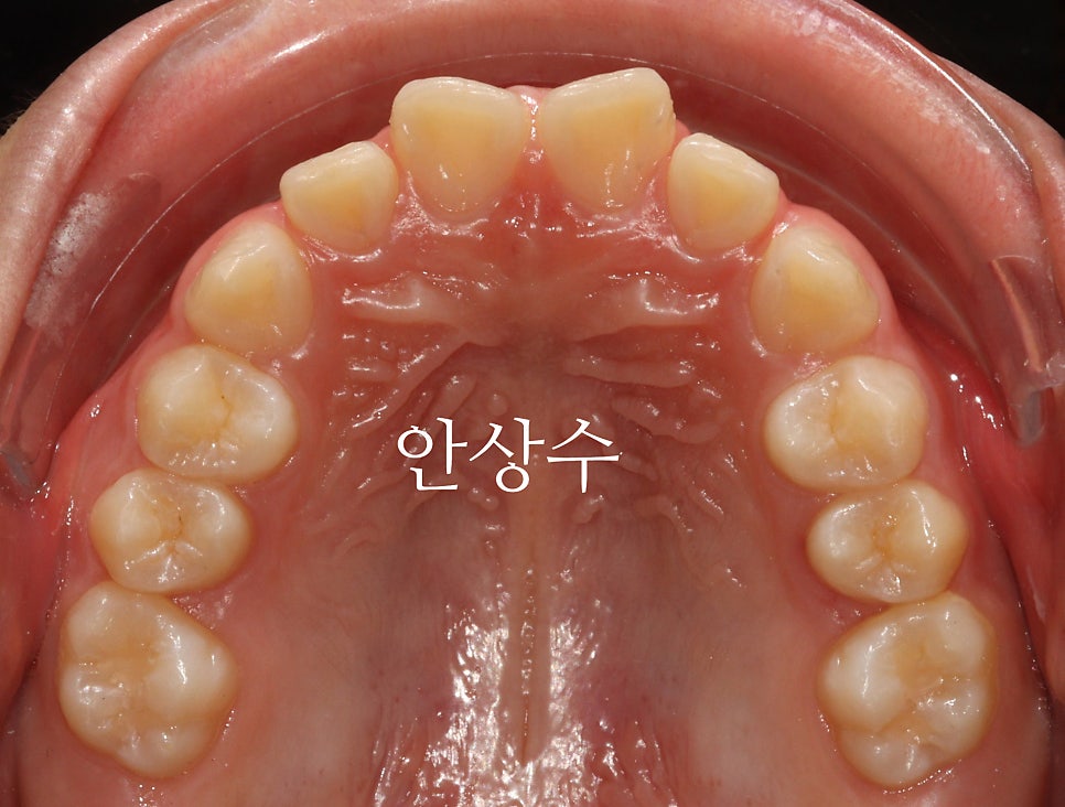 인비절라인 라이트 치료 모습 공유 돌출입? 2급 부정교합