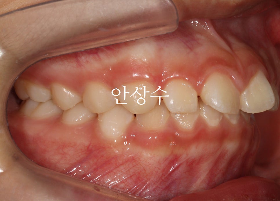 인비절라인 라이트 치료 모습 공유 돌출입? 2급 부정교합