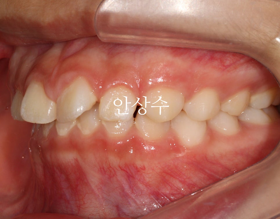 인비절라인 라이트 치료 모습 공유 돌출입? 2급 부정교합