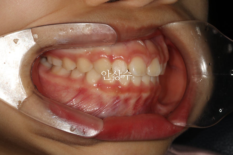 인비절라인 라이트 치료 모습 공유 돌출입? 2급 부정교합