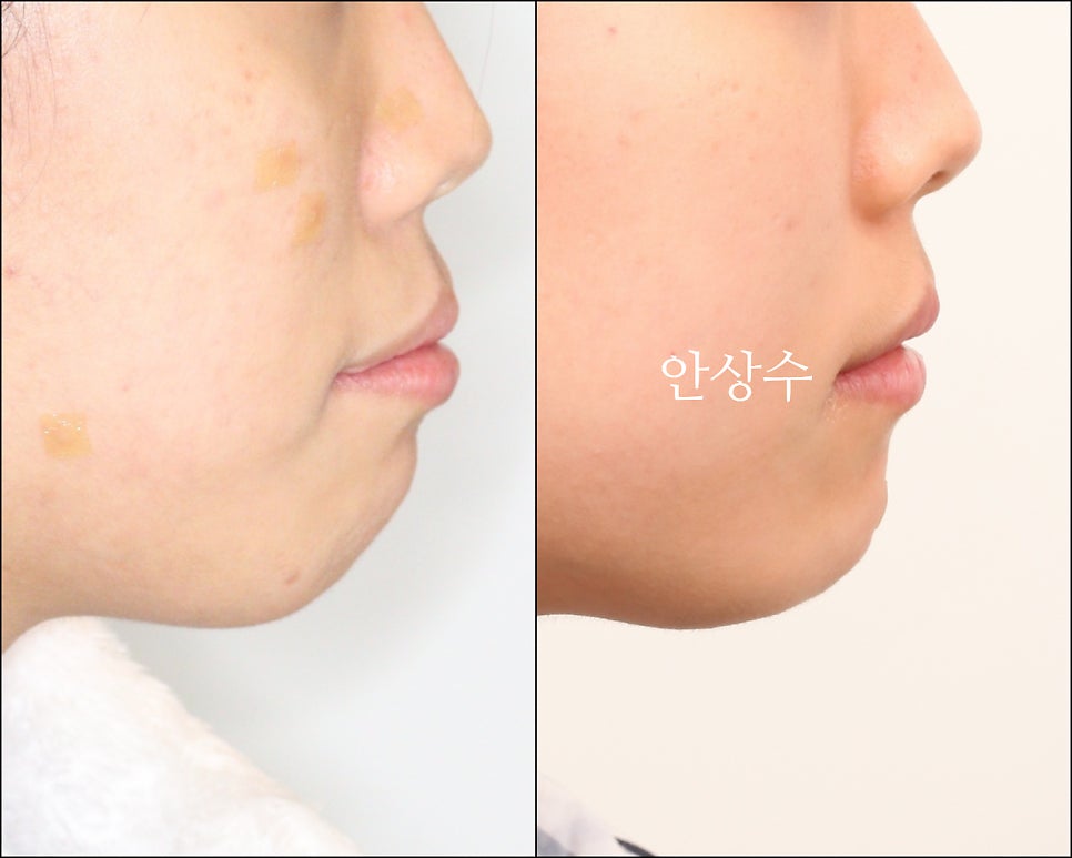 인비절라인 으로 발치 돌출입 교정 안모변화 결과 공유 입술변화 돌출입술