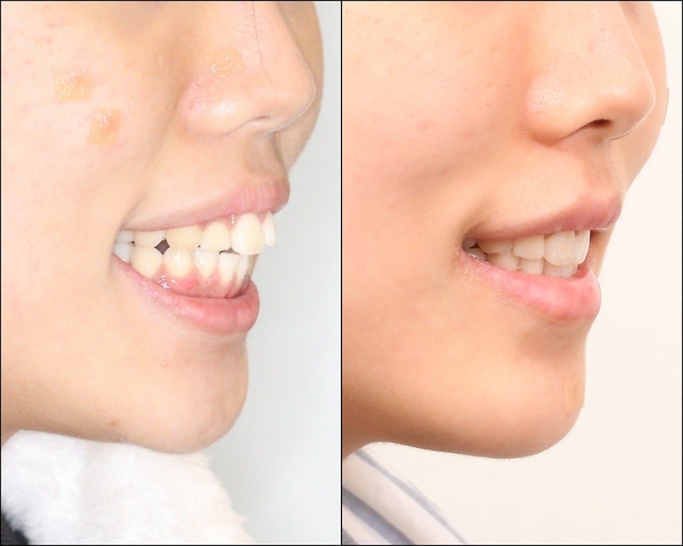 인비절라인 으로 발치 돌출입 교정 안모변화 결과 공유 입술변화 돌출입술