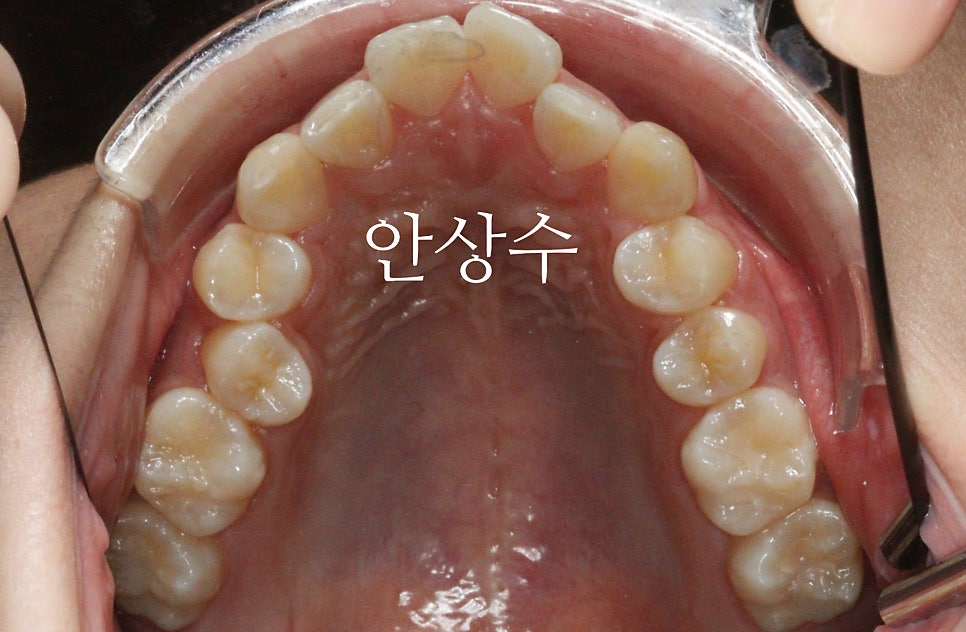 인비절라인 으로 발치 돌출입 교정 안모변화 결과 공유 입술변화 돌출입술
