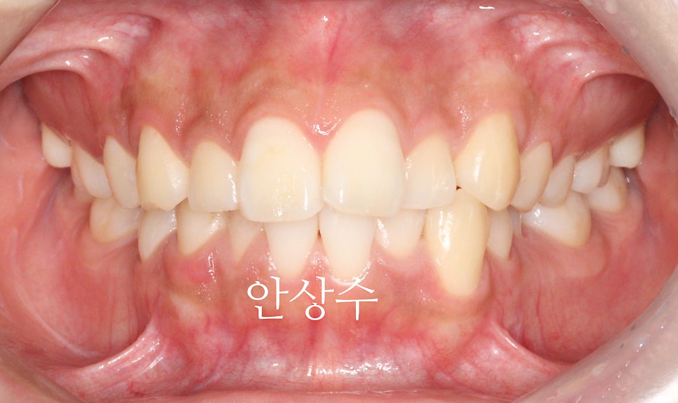 인비절라인 으로 발치 돌출입 교정 안모변화 결과 공유 입술변화 돌출입술