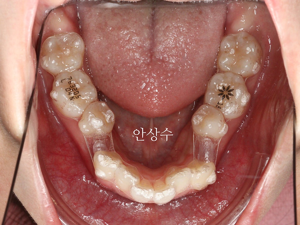 인비절라인 으로 발치 돌출입 교정 안모변화 결과 공유 입술변화 돌출입술