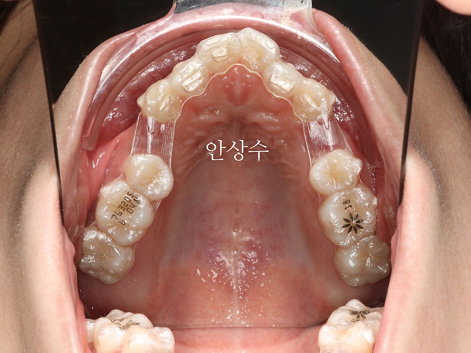 인비절라인 으로 발치 돌출입 교정 안모변화 결과 공유 입술변화 돌출입술