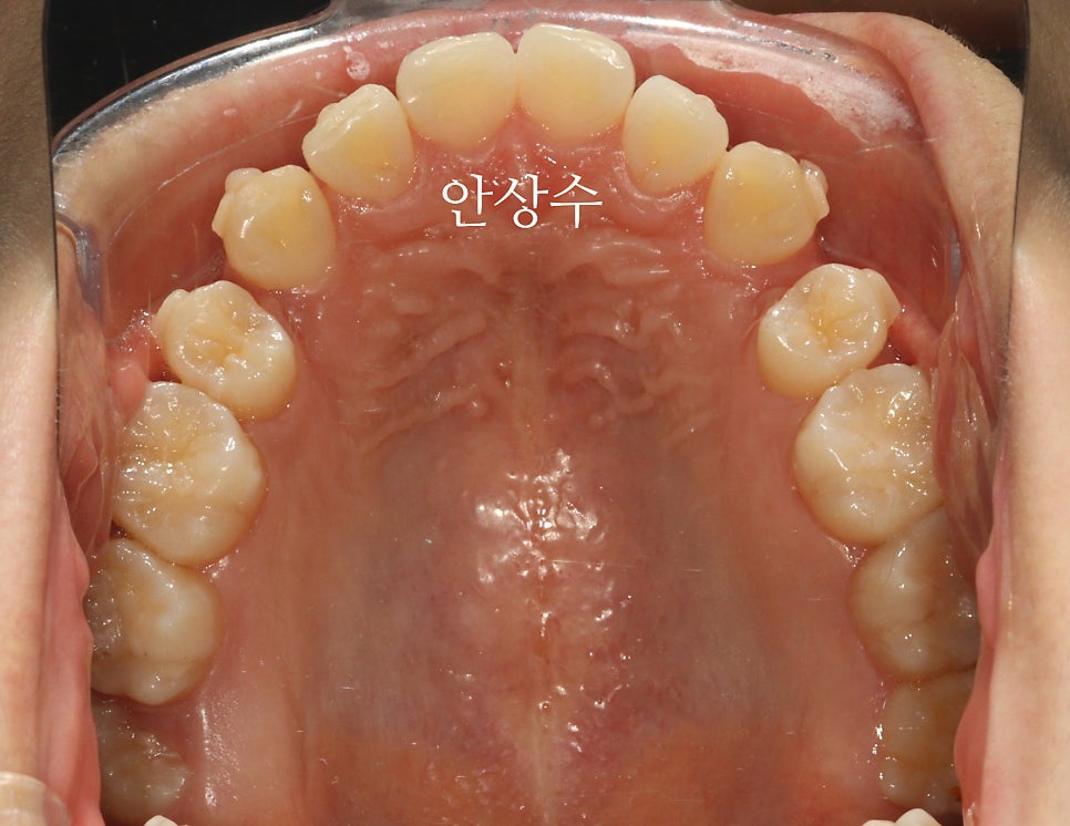 인비절라인 으로 발치 돌출입 교정 안모변화 결과 공유 입술변화 돌출입술