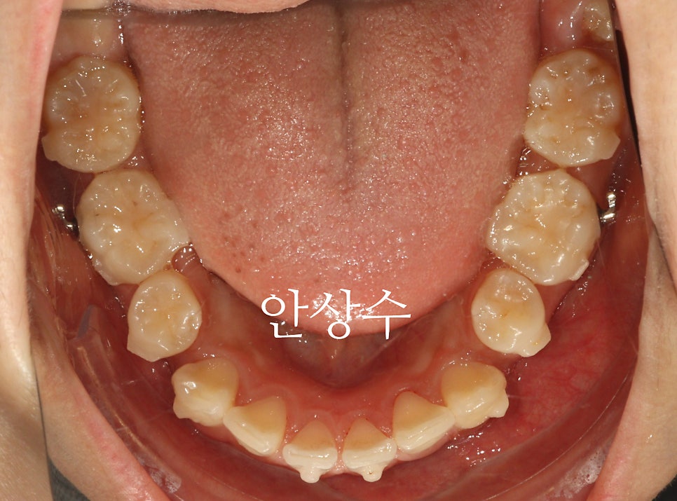 인비절라인 으로 발치 돌출입 교정 안모변화 결과 공유 입술변화 돌출입술