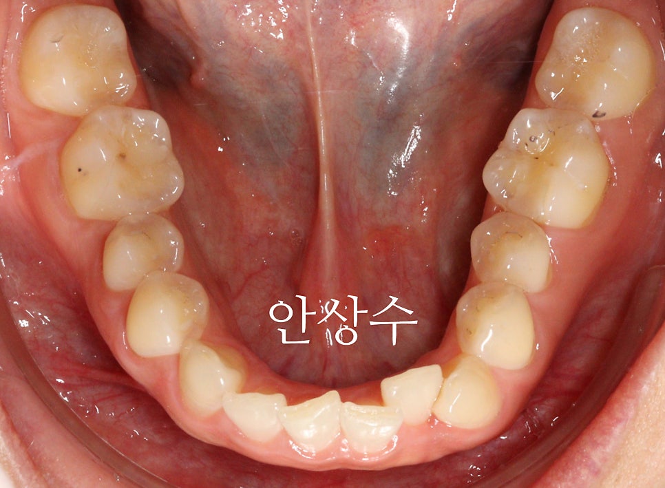 인비절라인 라이트 어디까지 되는 치료일까? 인비절라인 치료에 대해 알려드립니다. 14주동안 교정치료
