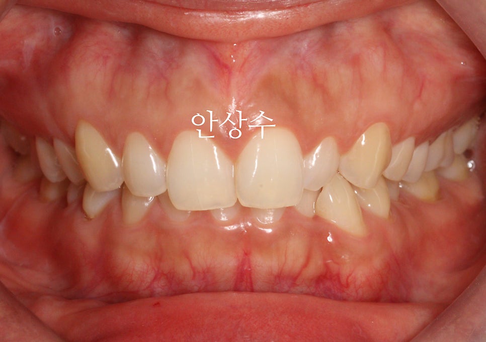 인비절라인 라이트 어디까지 되는 치료일까? 인비절라인 치료에 대해 알려드립니다. 14주동안 교정치료