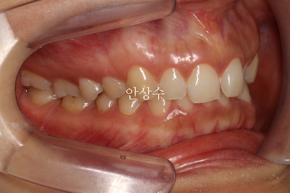 인비절라인 라이트 어디까지 되는 치료일까? 인비절라인 치료에 대해 알려드립니다. 14주동안 교정치료