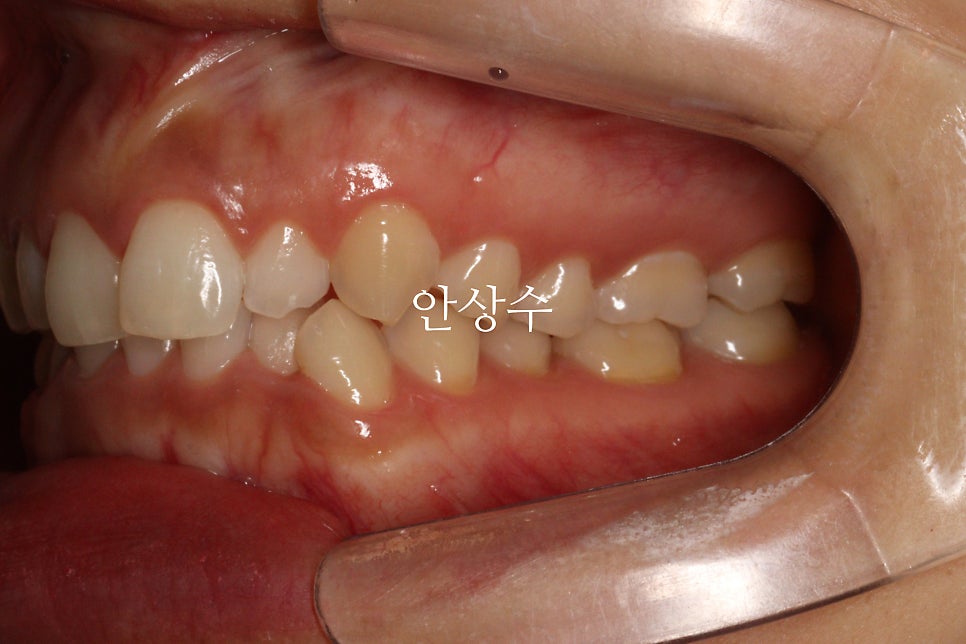 인비절라인 라이트 어디까지 되는 치료일까? 인비절라인 치료에 대해 알려드립니다. 14주동안 교정치료