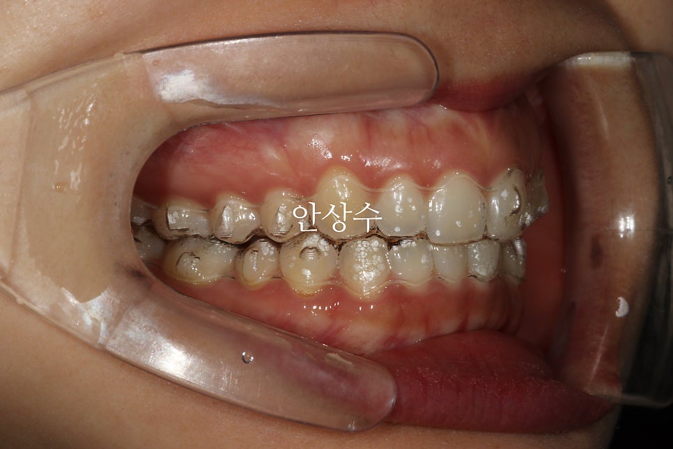 인비절라인 라이트 어디까지 되는 치료일까? 인비절라인 치료에 대해 알려드립니다. 14주동안 교정치료