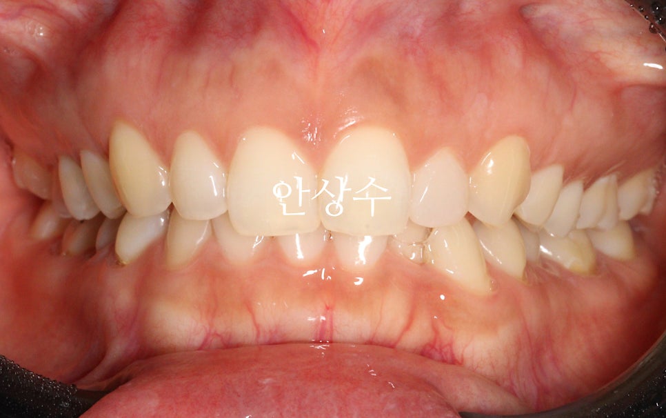 인비절라인 라이트 어디까지 되는 치료일까? 인비절라인 치료에 대해 알려드립니다. 14주동안 교정치료