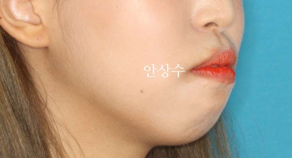 인천 돌출입 발치 소구치4개 클리피씨 교정 및 6년 후 유지상태