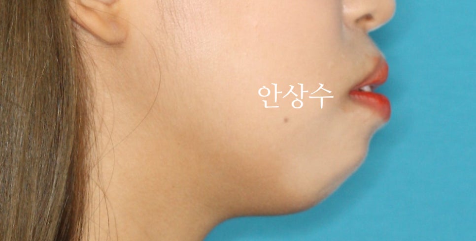 인천 돌출입 발치 소구치4개 클리피씨 교정 및 6년 후 유지상태