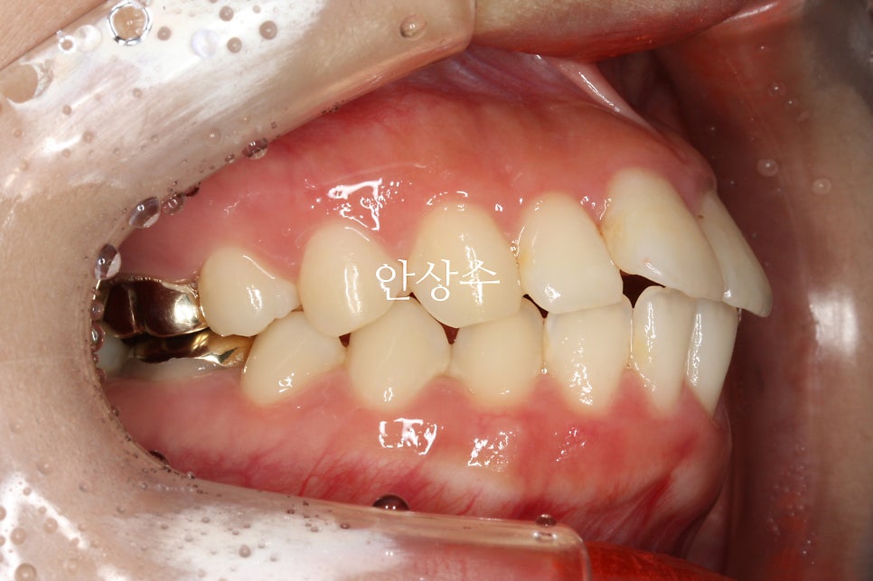 인천 돌출입 발치 소구치4개 클리피씨 교정 및 6년 후 유지상태