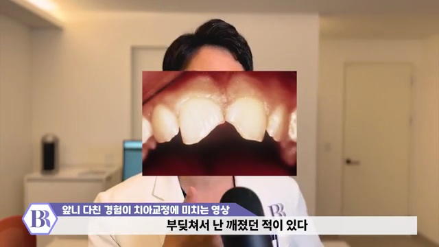 치아교정 진행이 안된다?! 치아가 뼈에 붙는 유착치!