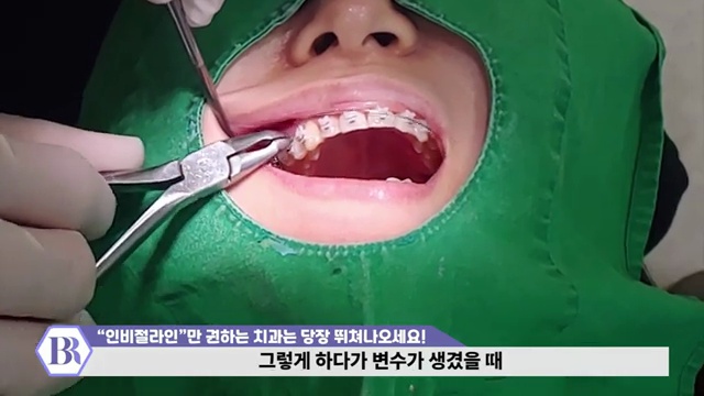 '인비절라인'만 권하는 치과는 당장 병원 뛰쳐나오세요! #인비절라인