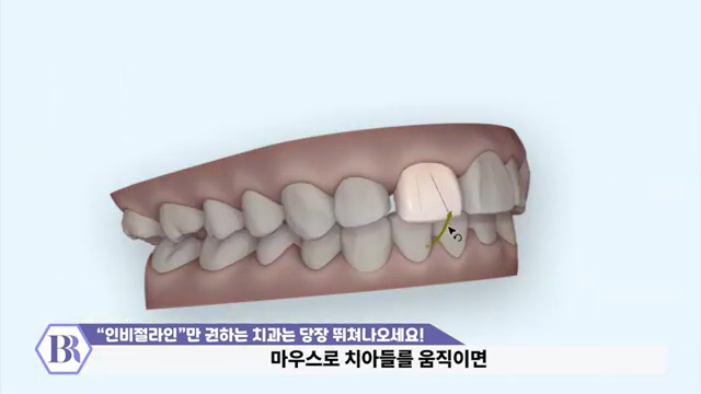 '인비절라인'만 권하는 치과는 당장 병원 뛰쳐나오세요! #인비절라인