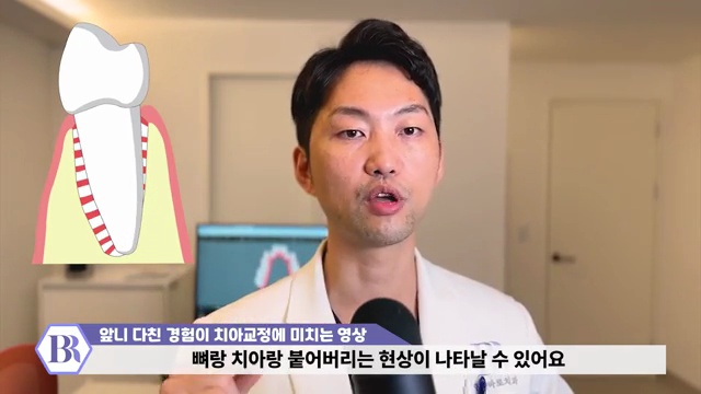 치아교정 진행이 안된다?! 치아가 뼈에 붙는 유착치!