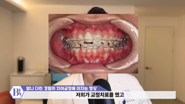 치아교정 진행이 안된다?! 치아가 뼈에 붙는 유착치!