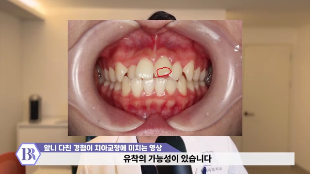 치아교정 진행이 안된다?! 치아가 뼈에 붙는 유착치!