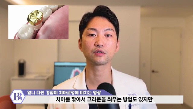 치아교정 진행이 안된다?! 치아가 뼈에 붙는 유착치!