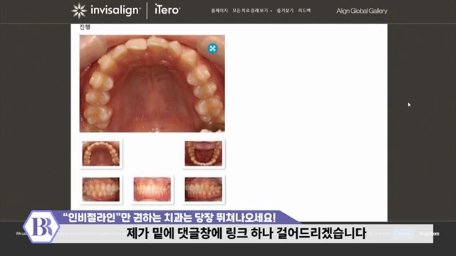 '인비절라인'만 권하는 치과는 당장 병원 뛰쳐나오세요! #인비절라인