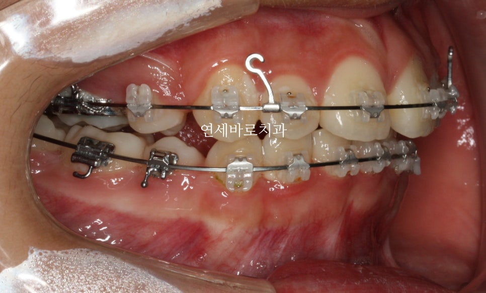 교정치과 상담시 물어볼 것들