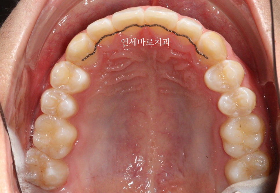교정치과 상담시 물어볼 것들