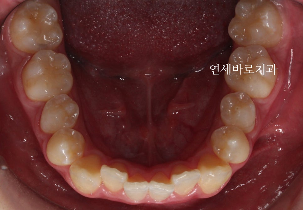 교정치과 상담시 물어볼 것들