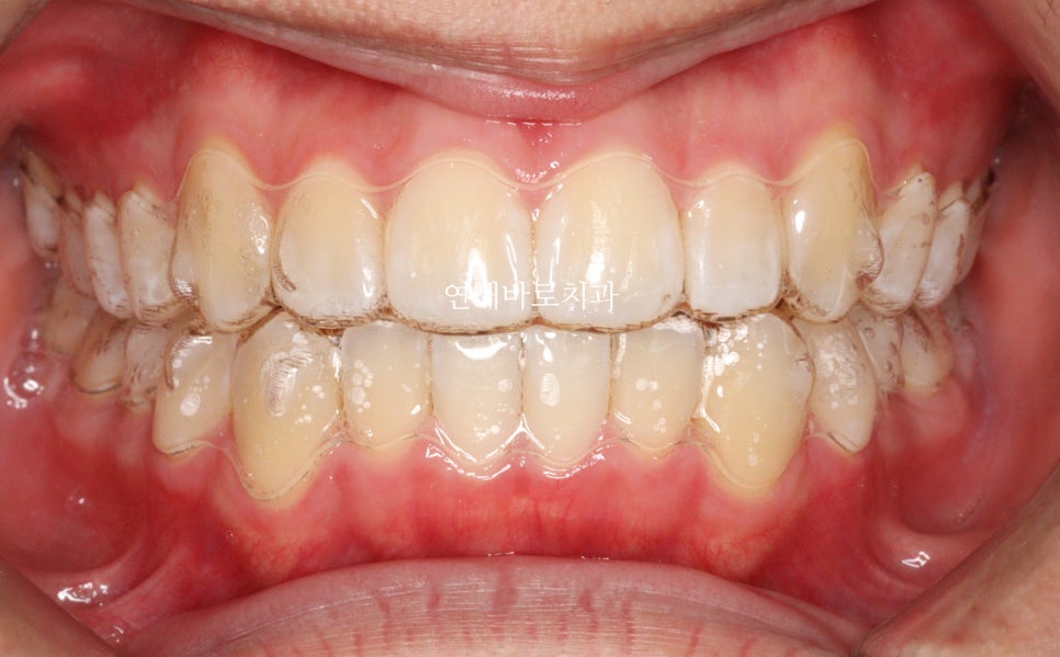 교정치과 상담시 물어볼 것들