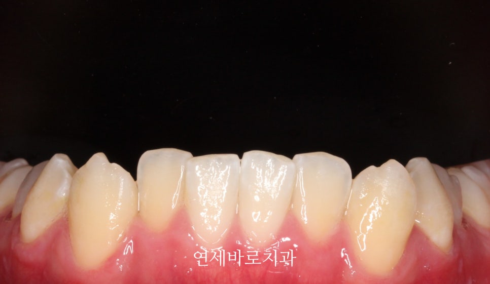 교정치과 상담시 물어볼 것들