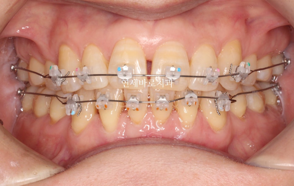 교정치과 상담시 물어볼 것들