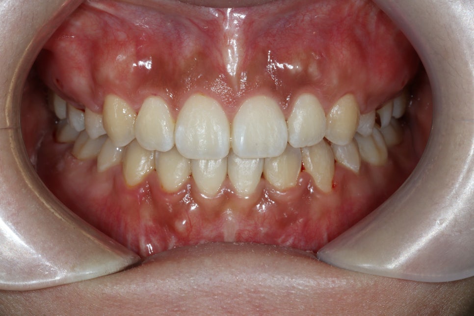 거미스마일 교정치료 전 후 비교