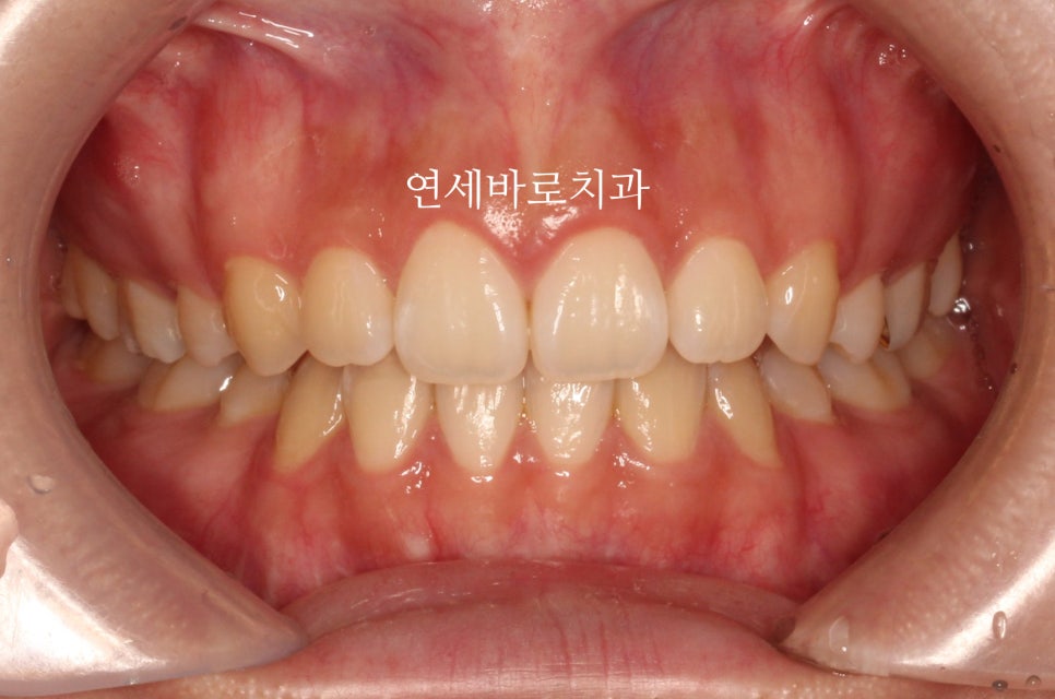 거미스마일 교정치료 전 후 비교