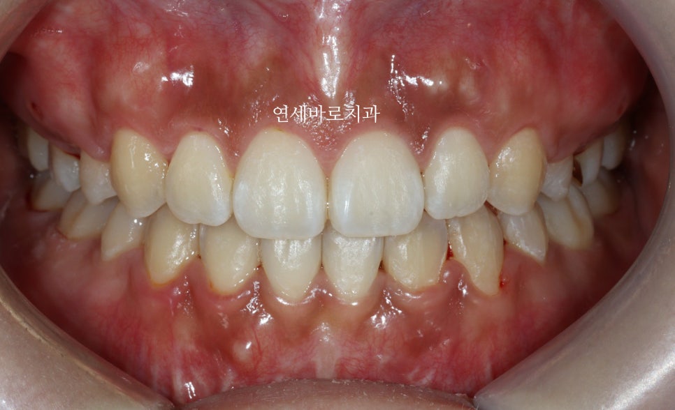 거미스마일 교정치료 전 후 비교