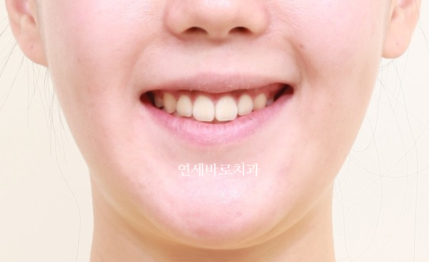 거미스마일 교정치료 전 후 비교
