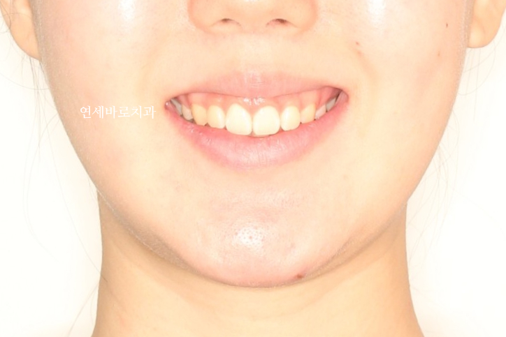 거미스마일 교정치료 전 후 비교