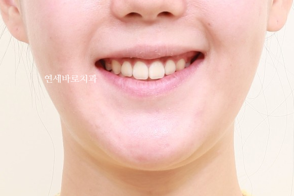 거미스마일 교정치료 전 후 비교