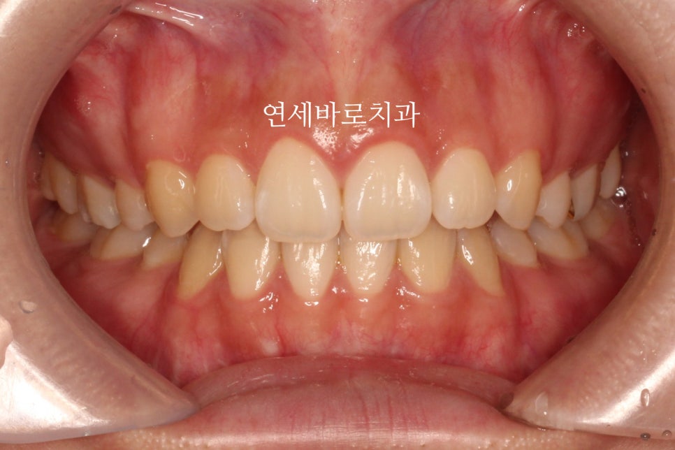 거미스마일 교정치료 전 후 비교