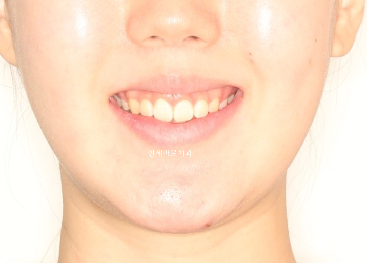 거미스마일 교정치료 전 후 비교