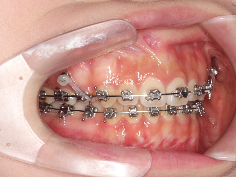 거미스마일 교정치료 전 후 비교